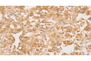 Immunohistochemistry of paraffin-embedded Human thyroid cancer tissue using CD24 Polyclonal Antibody at dilution of 1:40 (CD24 anticorps)