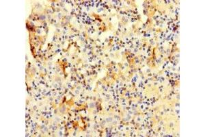 Immunohistochemistry of paraffin-embedded human lung cancer using ABIN7147985 at dilution of 1:100