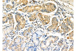 ABIN6265640 and ABIN6276987 at 1/100 staining Human gastric cancer and adjacent normal tissues by IHC-P.