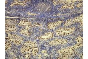 Immunohistochemical staining (Formalin-fixed paraffin-embedded sections) of human lung adenocarcinoma with NKX2-1 monoclonal antibody, clone G21-G . (NKX2-1 anticorps  (N-Term))
