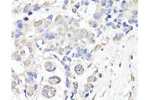 Immunohistochemistry of paraffin-embedded Human breast cancer using BAP1 Polyclonal Antibody at dilution of 1:150 (40x lens). (BAP1 anticorps)