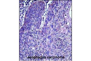 P3 Antibody (N-term)  iunohistochemistry analysis in formalin fixed and paraffin embedded human esophagus carcinoma followed by peroxidase conjugation of the secondary antibody and DAB staining.