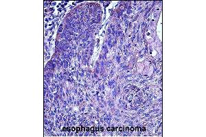 P3 Antibody (N-term)  iunohistochemistry analysis in formalin fixed and paraffin embedded human esophagus carcinoma followed by peroxidase conjugation of the secondary antibody and DAB staining. (MMP3 anticorps  (N-Term))