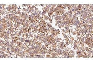 ABIN6278484 at 1/100 staining Human Melanoma tissue by IHC-P. (INHBC anticorps  (C-Term))