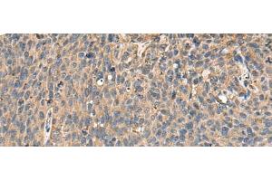 Immunohistochemistry of paraffin-embedded Human cervical cancer tissue using MRPL42 Polyclonal Antibody at dilution of 1:65(x200)