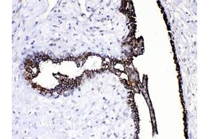 IHC testing of FFPE human breast cancer tissue with CASP8 antibody at 1ug/ml. (Caspase 8 anticorps  (AA 410-449))