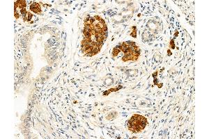 ABIN6263468 and ABIN6272966 at 1/100 staining Human pancreatic cancer by IHC-P. (MYH7 anticorps  (C-Term))