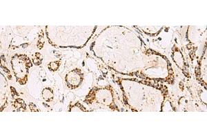 Immunohistochemistry of paraffin-embedded Human thyroid cancer tissue using ATP5O Polyclonal Antibody at dilution of 1:90(x200) (ATP5O anticorps)