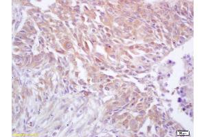 Formalin-fixed and paraffin embedded human lung carcinoma labeled with Rabbit Anti CDC37 Polyclonal Antibody, Unconjugated (ABIN706481) at 1:200 followed by conjugation to the secondary antibody and DAB staining (CDC37 anticorps  (AA 291-378))