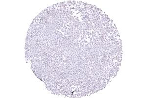 Breast Absence of E cadherin staining in a lobular breast cancer