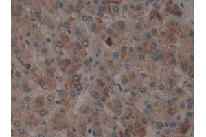 Detection of tPA in Human Liver cancer Tissue using Polyclonal Antibody to Tissue Plasminogen Activator (tPA)