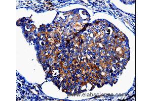 Immunohistochemistry of Human lung cancer using IL10RB Polyclonal Antibody at dilution of 1:60