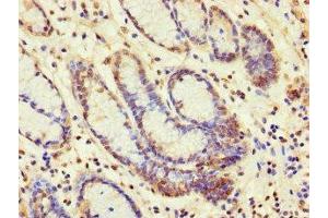 Immunohistochemistry of paraffin-embedded human gastric cancer using ABIN7160637 at dilution of 1:100