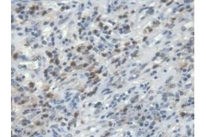 Detection of PIK3Cd in Human Colorectal cancer Tissue using Polyclonal Antibody to Phosphoinositide-3-Kinase Catalytic Delta Polypeptide (PIK3Cd)