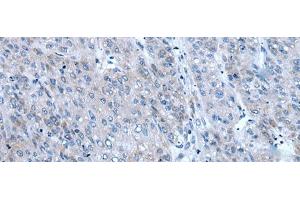 Immunohistochemistry of paraffin-embedded Human liver cancer tissue using ZIC1 Polyclonal Antibody at dilution of 1:65(x200) (ZIC1 anticorps)