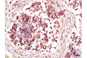 Formalin-fixed and paraffin embedded human lung carcinoma labeled with Anti-Phospho-MDM2(Thr218) Polyclonal Antibody, Unconjugated (ABIN802533) at 1:200 followed by conjugation to the secondary antibody and DAB staining (MDM2 anticorps  (pThr218))