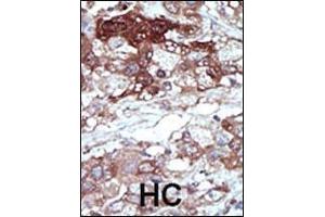 Formalin-fixed and paraffin-embedded human cancer tissue reacted with the primary antibody, which was peroxidase-conjugated to the secondary antibody, followed by DAB staining. (PEBP1 anticorps  (N-Term))