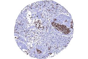 Colon Colorectal adenocarcinoma showing numerous S100A12 positive granulocytes in the stroma and within tumor glands
