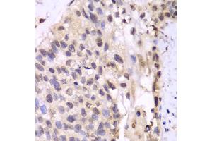 Immunohistochemistry of paraffin-embedded human lung cancer using PSMA6 antibody. (PSMA6 anticorps)