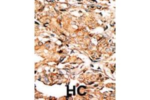 Formalin-fixed and paraffin-embedded human hepatocellular carcinoma tissue reacted with RAD9A (phospho S277) polyclonal antibody  which was peroxidase-conjugated to the secondary antibody followed by AEC staining. (RAD9A anticorps  (pSer272))
