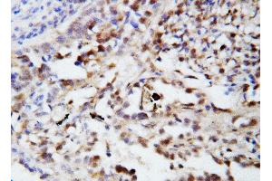Anti-Ubiquitin antibody, IHC(P) IHC(P): Human Lung Cancer Tissue (Ubiquitin B anticorps  (N-Term))