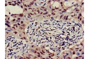 Immunohistochemistry of paraffin-embedded human lung cancer using ABIN7145371 at dilution of 1:100