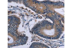 Immunohistochemistry of Human colon cancer using IPO4 Polyclonal Antibody at dilution of 1:50 (Importin 4 anticorps)