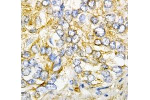 IHC-P: AIMP2 antibody testing of human rectal cancer tissue (AIMP2 anticorps  (AA 298-320))
