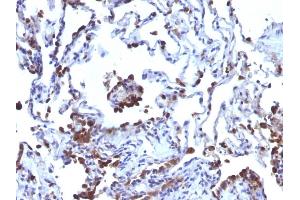 Formalin-fixed, paraffin-embedded human Melanoma metastasized to Lung stained with CD63 Monoclonal Antibody (NKI/C3 + LAMP3/968) (CD63 anticorps)