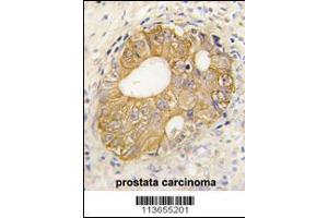 Formalin-fixed and paraffin-embedded human prostata carcinoma tissue reacted with CDH3 antibody , which was peroxidase-conjugated to the secondary antibody, followed by DAB staining.