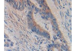 Detection of GLDC in Human Colorectal cancer Tissue using Polyclonal Antibody to Glycine Dehydrogenase (GLDC)