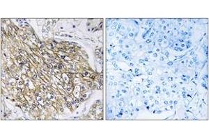 Immunohistochemistry analysis of paraffin-embedded human breast carcinoma tissue, using LPHN2 Antibody. (LPHN2 anticorps  (AA 551-600))