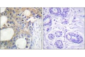 Immunohistochemistry analysis of paraffin-embedded human breast carcinoma tissue, using CD227/MUC1 (Ab-1229) Antibody. (MUC1 anticorps  (AA 1201-1250))