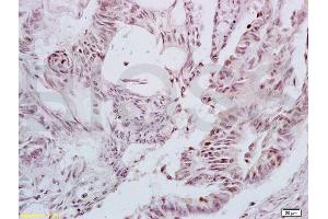 Formalin-fixed and paraffin embedded human colon carcinoma tissue labeled with Anti-LEF-1 Polyclonal Antibody, Unconjugated (ABIN735248) at 1:200 followed by conjugation to the secondary antibody and DAB staining (LEF1 anticorps  (AA 331-399))