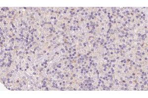 ABIN6273122 at 1/100 staining Human lymph cancer tissue by IHC-P. (HERPUD1 anticorps  (N-Term))