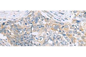 Immunohistochemistry of paraffin-embedded Human esophagus cancer tissue using PPIC Polyclonal Antibody at dilution of 1:50(x200)