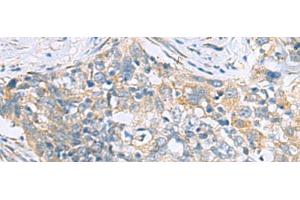 Immunohistochemistry of paraffin-embedded Human esophagus cancer tissue using PPIC Polyclonal Antibody at dilution of 1:50(x200)