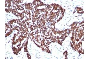 Immunohistochemical staining (Formalin-fixed paraffin-embedded sections) of human ovarian carcinoma with CCNB1 monoclonal antibody, clone CCNB1/1098 .