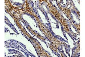 Paraffin embedded human gastric cancer tissue was stained with Goat Anti-Type I Collagen-BIOT, DAB, and hematoxylin.