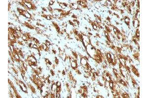 Formalin-fixed, paraffin-embedded human Rhabdomyosarcoma stained with Muscle Specific Actin Mouse Monoclonal Antibody (MSA/953). (ACTA1/ACTA2A/ACTG2 anticorps)
