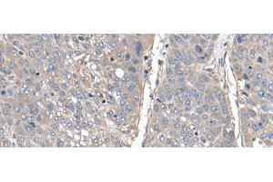 Immunohistochemistry of paraffin-embedded Human liver cancer tissue using THAP10 Polyclonal Antibody at dilution of 1:40(x200) (THAP10 anticorps)