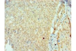 Immunohistochemistry of paraffin-embedded human cervical cancer using ABIN7166161 at dilution of 1:100 (SSX2 anticorps  (AA 1-188))
