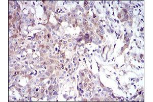 Immunohistochemical analysis of paraffin-embedded esophageal cancer tissues using UBE2C mouse mAb with DAB staining.