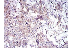 Immunohistochemical analysis of paraffin-embedded esophageal cancer tissues using UBE2C mouse mAb with DAB staining. (UBE2C anticorps  (AA 1-179))
