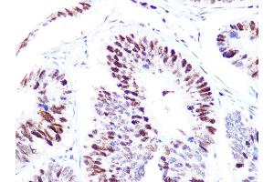 Immunohistochemistry of paraffin-embedded human colon carcinoma using p60 C Rabbit mAb  at dilution of 1:100 (40x lens). (CHAF1B anticorps)