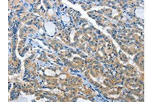 The image on the left is immunohistochemistry of paraffin-embedded Human thyroid cancer tissue using ABIN7192019(PRKX Antibody) at dilution 1/15, on the right is treated with synthetic peptide.