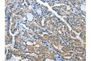The image on the left is immunohistochemistry of paraffin-embedded Human thyroid cancer tissue using ABIN7192019(PRKX Antibody) at dilution 1/15, on the right is treated with synthetic peptide. (PRKX anticorps)
