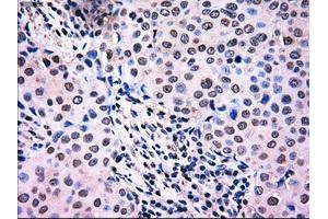 Immunohistochemical staining of paraffin-embedded Adenocarcinoma of breast tissue using anti-NRBP1 mouse monoclonal antibody. (NRBP1 anticorps)