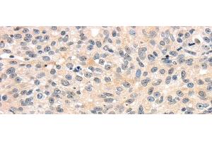 Immunohistochemistry of paraffin-embedded Human breast cancer tissue using TRIB3 Polyclonal Antibody at dilution 1:40 (TRIB3 anticorps)