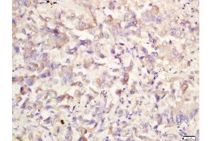 Formalin-fixed and paraffin embedded human lung carcinoma labeled with Rabbit Anti-ATG1/ULK1 Polyclonal Antibody, Unconjugated 1:200 followed by conjugation to the secondary antibody and DAB staining (ULK1 anticorps  (AA 951-1050))